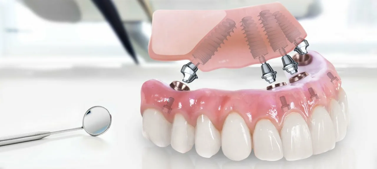 Протезування зубів